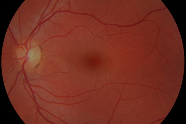 RETINA